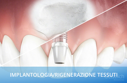 Home Trattamenti Implantologia Rigenerazione Tessuti